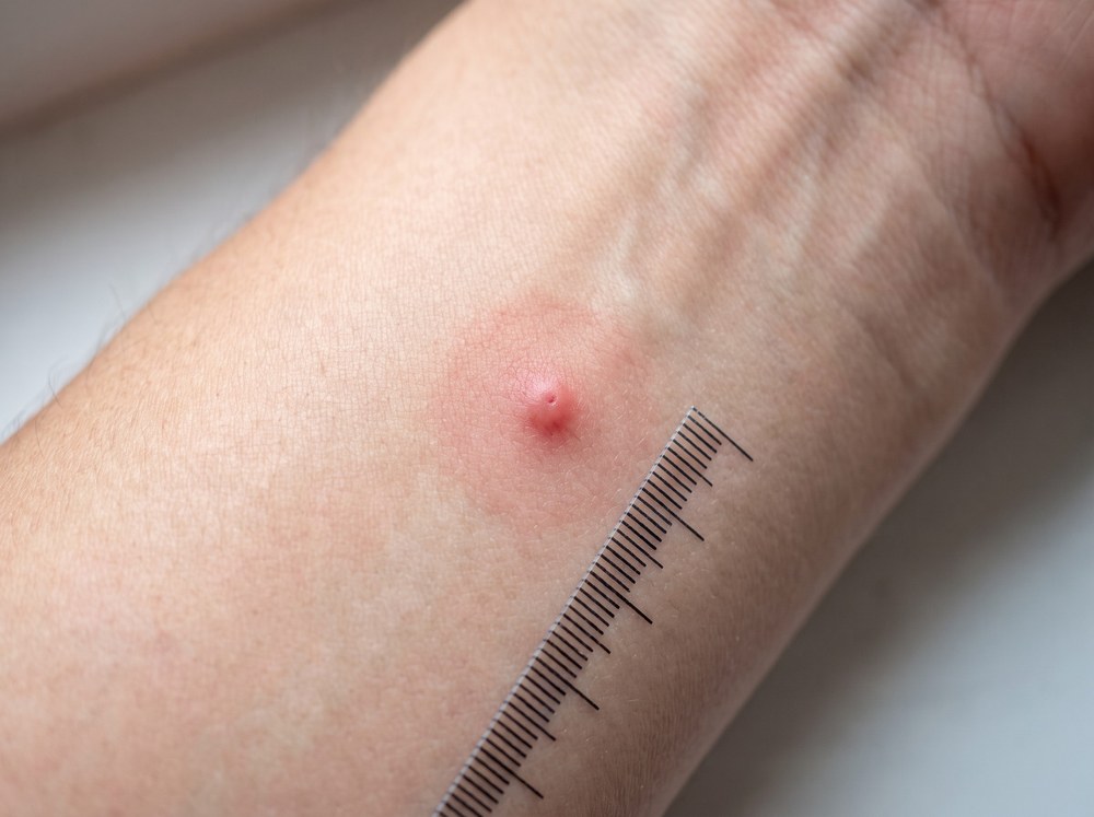 Close-up of a fresh American dog tick bite site showing a small red bump with mild surrounding redness after tick removal