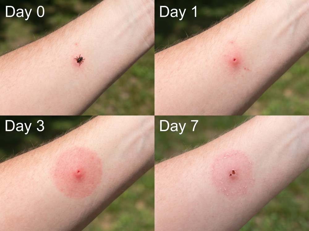 Side-by-side labeled comparison of an American dog tick and a smaller deer tick showing differences in size and shield markings